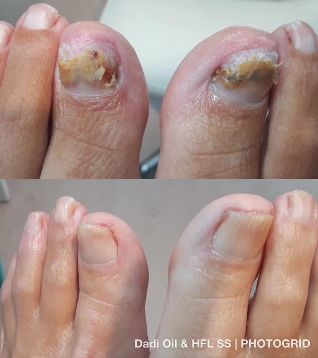 De Nummer 1 Tegen Schimmelnagels! - HFL - Laboratories - Solution Spray - 50ml + Dadi'Oil Nagelriem Olie - 3.75ml - Kalknagel Spray - Schimmelnagel Spray - Nagelriem Olie - Nagelverzorging 6 De Nummer 1 Tegen Schimmelnagels! - HFL - Laboratories - Solution Spray - 50ml + Dadi'Oil Nagelriem Olie - 3.75ml - Kalknagel Spray - Schimmelnagel Spray - Nagelriem Olie - Nagelverzorging - Afbeelding 4