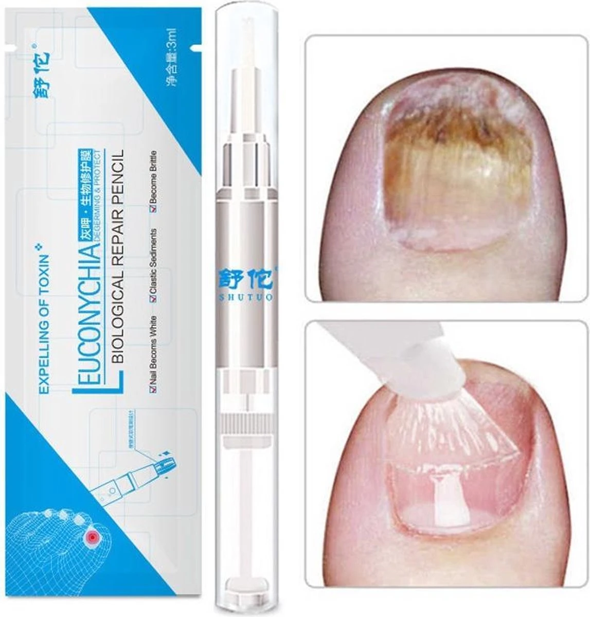 Anti- Kalknagel Behandeling Puur Natuur 3 Anti- Kalknagel Behandeling Puur Natuur