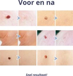 Steelwratjes Verwijderaar - Steelwratjes Verwijderen - Pijnloos En Snel - Wrattenverwijderaar - Steelwratten 11 Steelwratjes Verwijderaar - Steelwratjes Verwijderen - Pijnloos En Snel - Wrattenverwijderaar - Steelwratten -Lichaamsverzorging Winkel 1148x1200