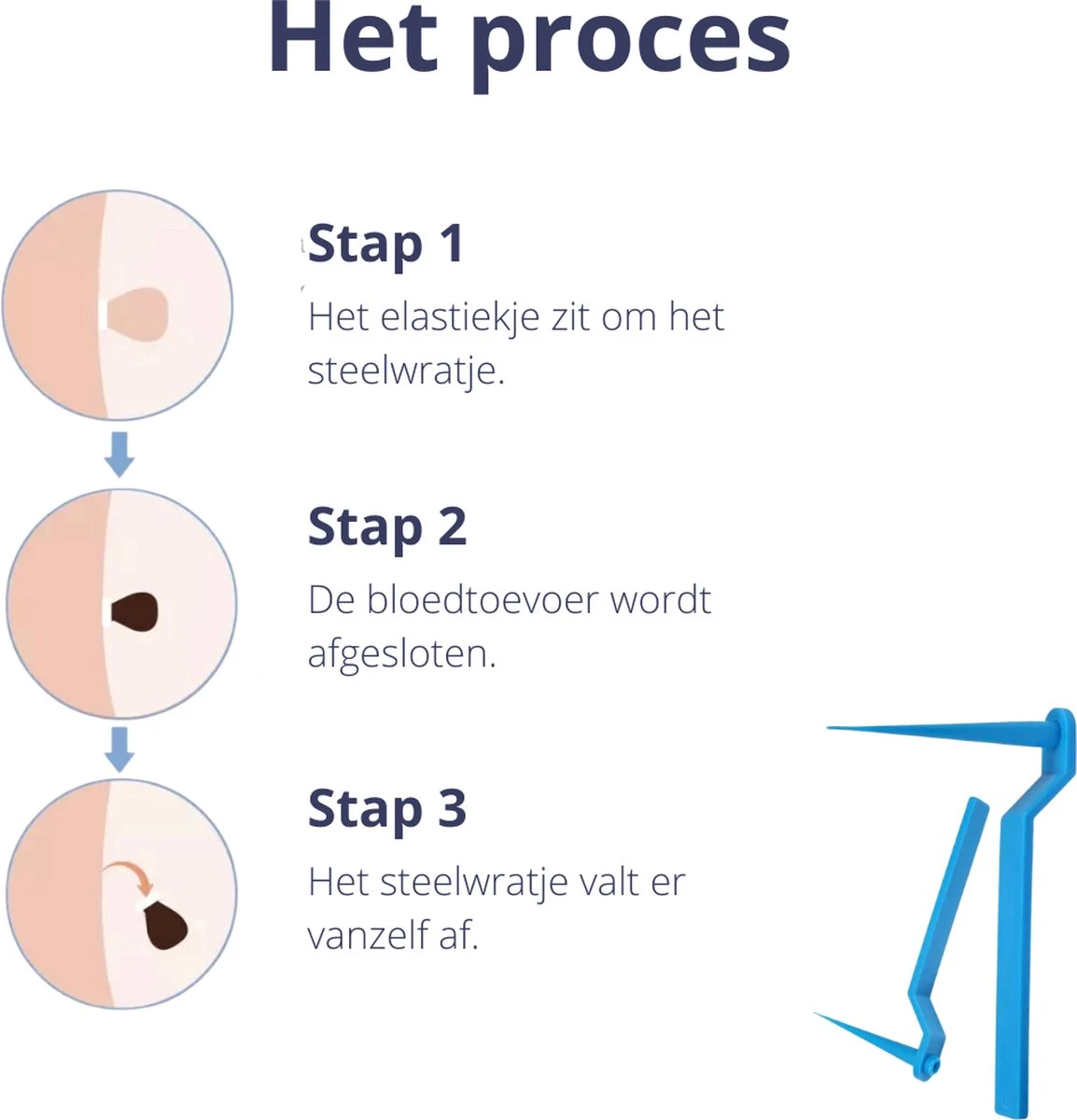 Steelwratjes Verwijderaar - Steelwratjes Verwijderen - Pijnloos En Snel - Wrattenverwijderaar - Steelwratten 5 Steelwratjes Verwijderaar - Steelwratjes Verwijderen - Pijnloos En Snel - Wrattenverwijderaar - Steelwratten - Afbeelding 3