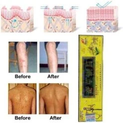 Psoriasis/exzeem Chineese Creme 15 Psoriasis/exzeem Chineese Creme -Lichaamsverzorging Winkel 1195x1200 24