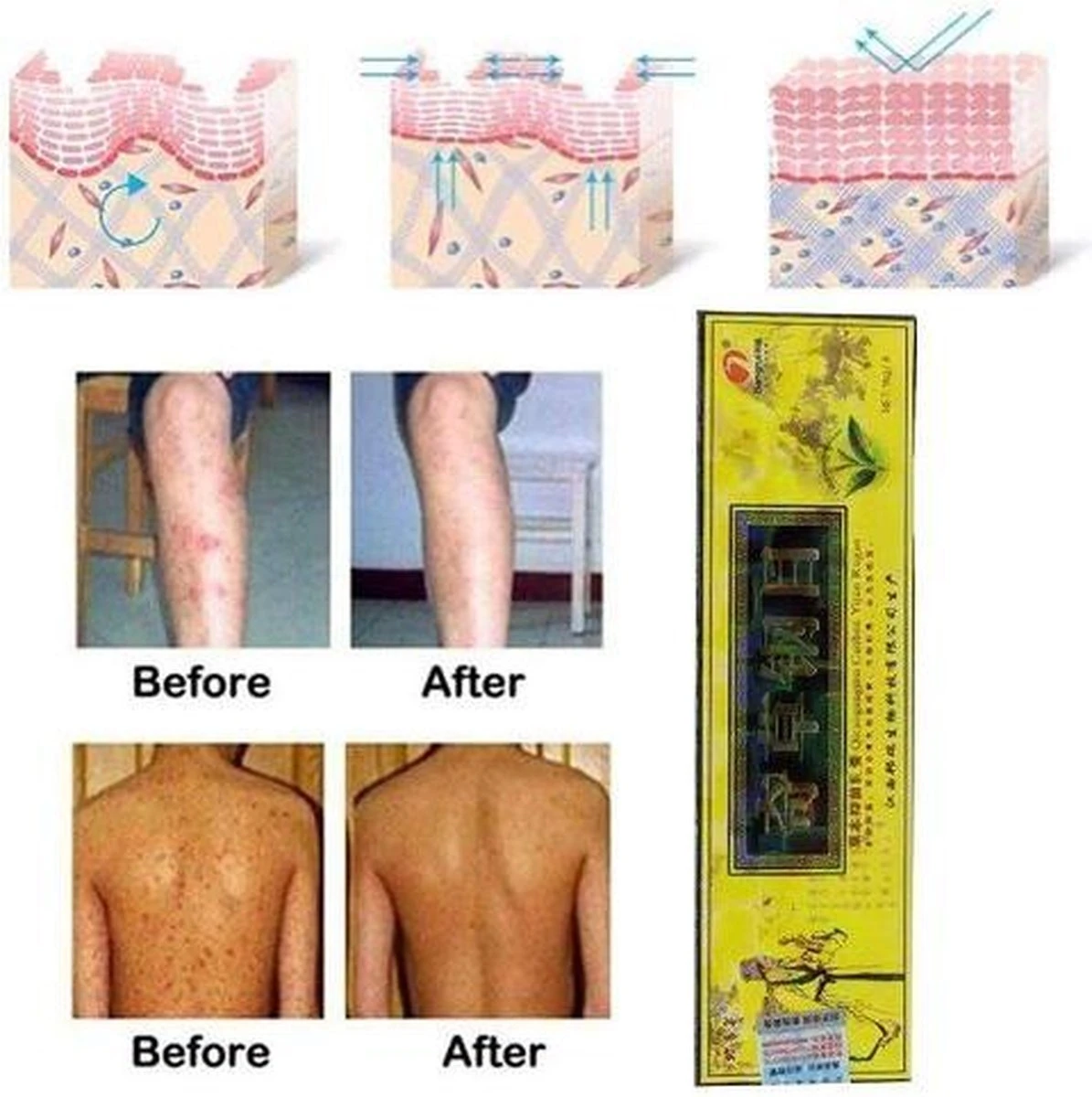 Psoriasis/exzeem Chineese Creme 6 Psoriasis/exzeem Chineese Creme - Afbeelding 4