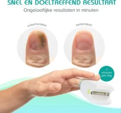 Anti Schimmelnagel Zelf-laserapparaat Incl. Pedicure Set -Lichaamsverzorging Winkel 1200x1120 2