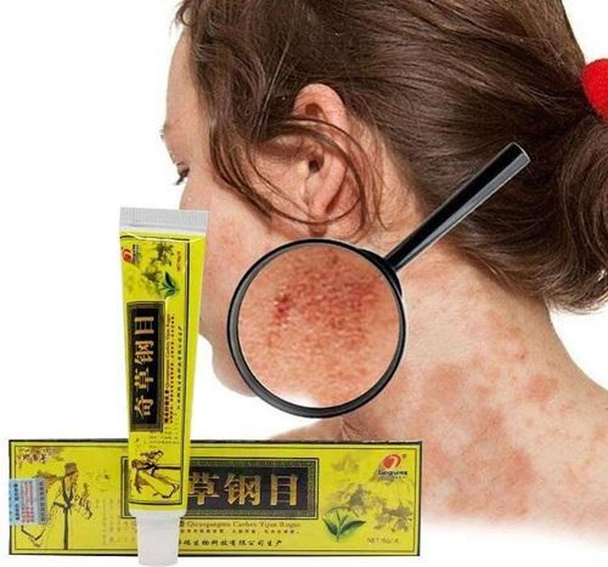 Psoriasis/exzeem Chineese Creme 3 Psoriasis/exzeem Chineese Creme