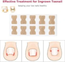 Merkloos Ingegroeide Teennagel Corrector -Lichaamsverzorging Winkel 1200x1146