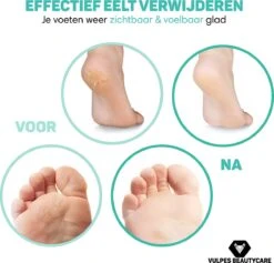 Vulpes BeautyCare® Elektrische Eelt Verwijderaar Pro – Stofzuigfunctie – 3 Snelheden – Inclusief 3 Vijlschijven & Borstel - USB-Oplaadbaar 13 Vulpes BeautyCare® Elektrische Eelt Verwijderaar Pro – Stofzuigfunctie – 3 Snelheden – Inclusief 3 Vijlschijven & Borstel - USB-Oplaadbaar -Lichaamsverzorging Winkel 1200x1149 2