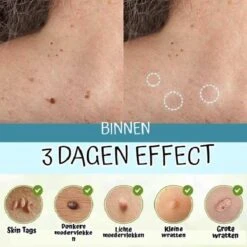 Skini™ - Moedervlekken & Wratten & Skin Tags Verwijderaar | Moedervlekken Verwijderaar | Wratten Verwijderaar | Moedervlekken Verwijderen | Wratten Verwijderen | Fibroom Verwijderen | Skin Tag Verwijderen | Steelwratjes Verwijderen -Lichaamsverzorging Winkel 1200x1200 2355