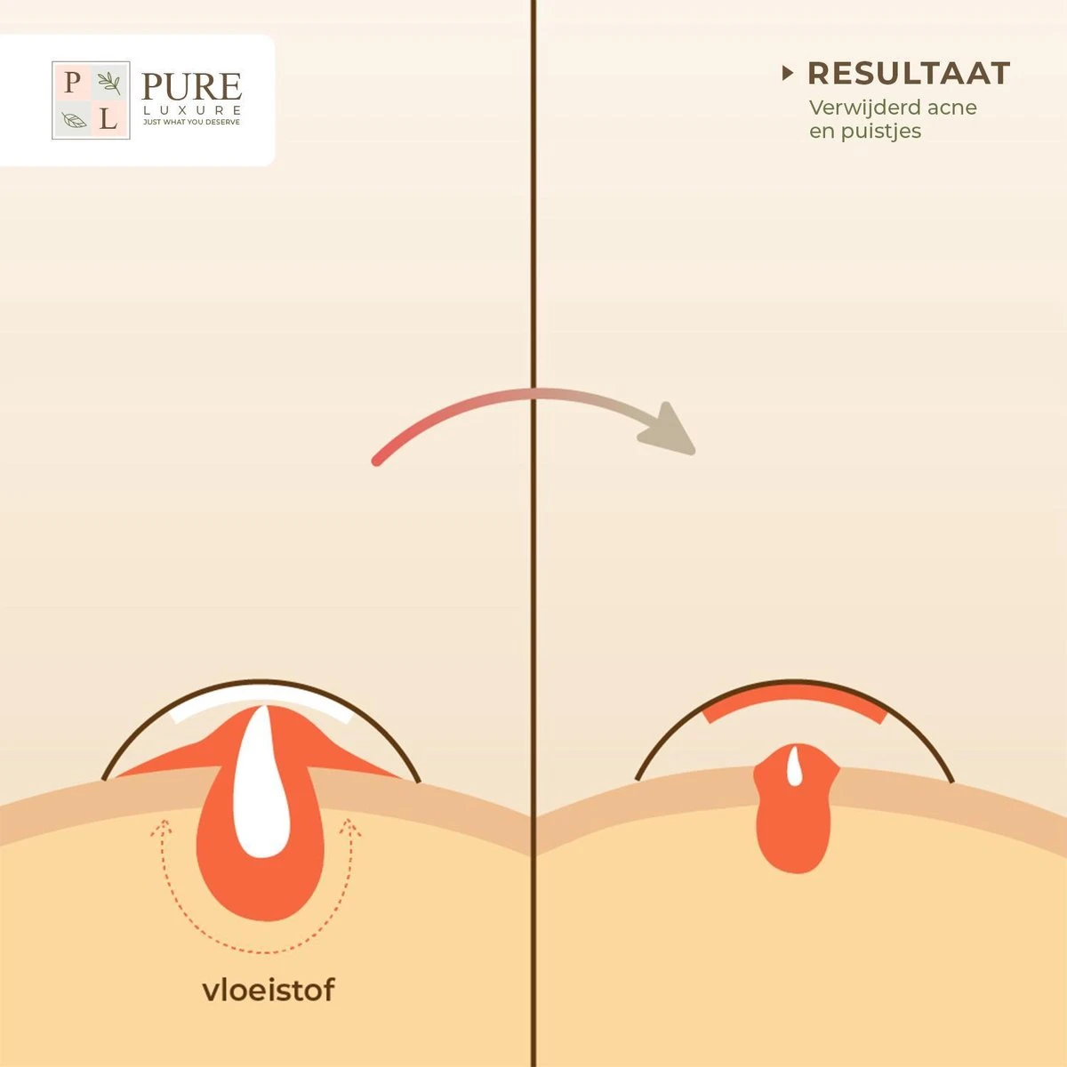 Pimple Patch 144 ST - Acne Patch - Acne - Acne Pleister - Pimple Patches - Puisten Verwijderaar 10 Pimple Patch 144 ST - Acne Patch - Acne - Acne Pleister - Pimple Patches - Puisten Verwijderaar - Afbeelding 8