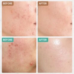 Jinius ® - Pimple Patches - Pimple Patch - Acne Patch - Puisten Verwijderaar - Puisten Pleister - Acne Pleister - Acne Sticker - Puistjes Verwijderen - 108 Stuks -Lichaamsverzorging Winkel 1200x1200 834