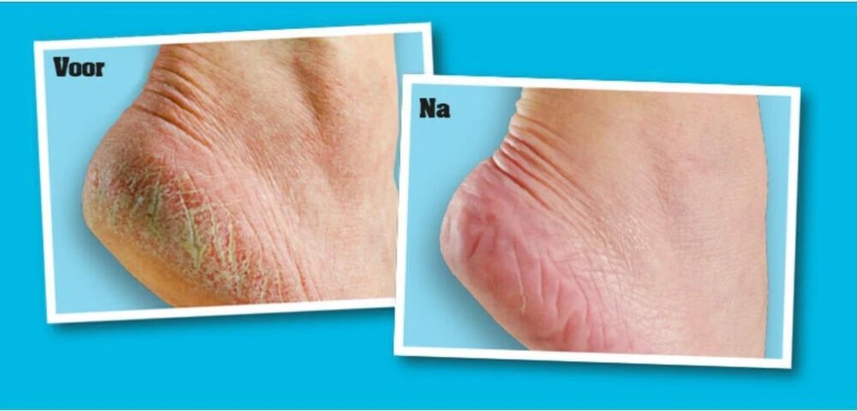 O'Keeffe's - Voetencreme - Voor Gezonde Voeten - Potje 96 Gram 4 O'Keeffe's - Voetencreme - Voor Gezonde Voeten - Potje 96 Gram - Afbeelding 2