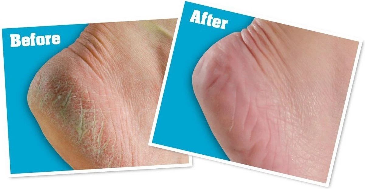 O'Keeffe's - Voetencreme - Voor Gezonde Voeten - Potje 96 Gram 8 O'Keeffe's - Voetencreme - Voor Gezonde Voeten - Potje 96 Gram - Afbeelding 6