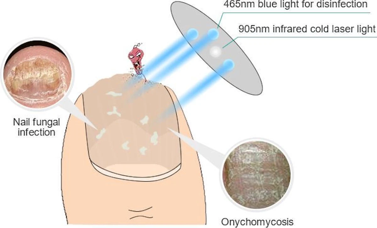 Anti Schimmelnagel Kalknagel Laserapparaat Om Zelf Te Behandelen, Veilig, Effectief, Snel En Pijnloos, Koude Laser Behandeling Voor Thuisgebruik, Voor Tenen En Vingers. Oplaadbaar. 4 Anti Schimmelnagel Kalknagel Laserapparaat Om Zelf Te Behandelen, Veilig, Effectief, Snel En Pijnloos, Koude Laser Behandeling Voor Thuisgebruik, Voor Tenen En Vingers. Oplaadbaar. - Afbeelding 2